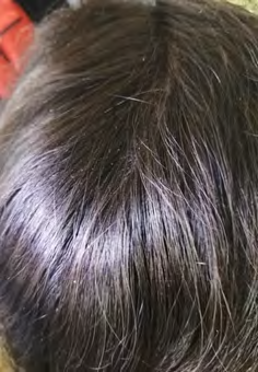 Figure 1: Clinical image showing shiny hair.