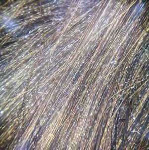 Figure 2: Trichoscopy of the shiny hair of the second girl showing alternation of light and dark bands.