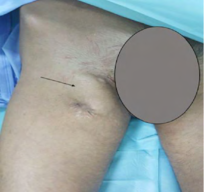 Figure 1: Inguinal localization of extra-skeletal Ewing’s sarcoma.
