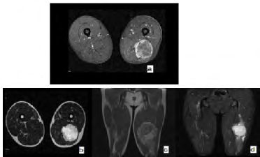 Figure 10: MRI of the left thigh in sections: (a) frontal T1 C+ (b) frontal T2 (c) sagittal T1 (d) T2 FATSAT showing the presence at the left posterior crural compartment at the inter-aponeurotic compartment and in the path of the great sciatic nerve of a tissue formation described as hyposignal T1, hypersignal T2, unmodified in FATSAT sequence, heterogeneously and intensely enhanced after contrast. It is encapsulated, lobulated in contour and maintains clear interfaces with the surrounding muscles.
