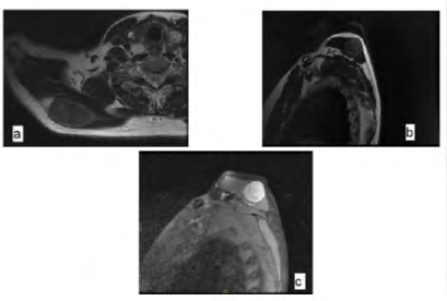 Figure 11: MRI of the right shoulder in sections (a) coronal T1 (b) sagittal T2 (c) sagittal T1C+ showing the presence in the posterior region of the right scapula at the expense of the great dorsal muscle of a rounded, well circumscribed tissue mass measuring 52x32x33mm, described in hypersignal T2 and STIR, iso T1, significantly enhanced after injection of Gadolinium.