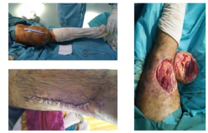 Figure 13: Large resection in a patient with myxoid liposarcoma grade II.