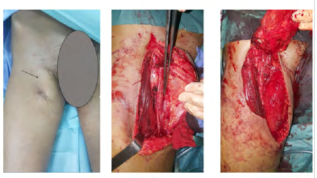 Figure 14: Surgical resection of extra-skeletal Ewing’s sarcoma.