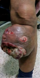 Figure 3: localized sarcoma of the leg.