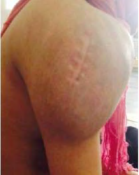 Figure 4: Shoulder sarcoma.