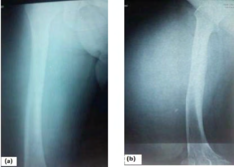 Figure 7: Soft tissue ultrasonography showing a heterogeneous hyper-echogenic tissue mass of the anterior compartment of the right thigh.