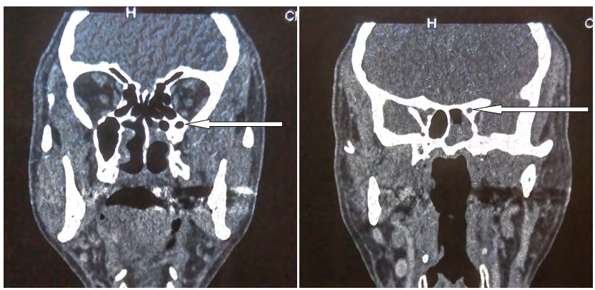 Figure 2: Coronal CT images showing a mite-like appearance at the base of the skull related to osteoradionecrosis in a 50-year- old patient followed for pharyngeal carcinoma, treated by radiotherapy and concomitant chemotherapy.