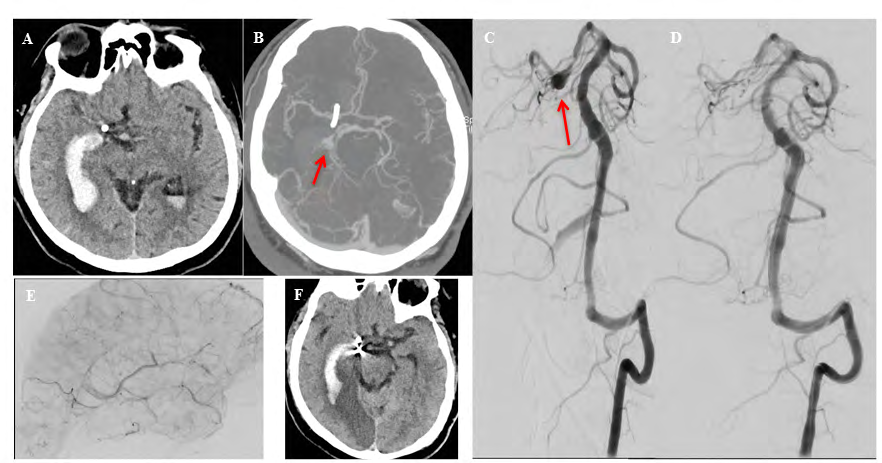Figure 2: Patient presented with sudden severe headache with CT scan of head showing intraventricular hemorrhage (A) and CT angiogram showing a fusiform aneurysm (arrow), likely dissecting in nature, of the right PCA (B); DSA during the PAO procedure re-demonstrates the PCA aneurysm (arrow, C). Post-interventional DSA shows the aneurysm was occluded completely with no residual filling (D) and delayed filling of the distal PCA via collaterals (E); Post-interventional CT, after 2 days, shows infarct in the right PCA territory (F).