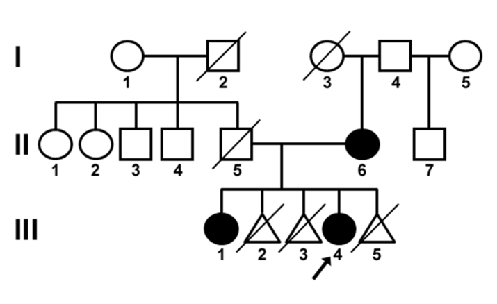 Figure 1: Pedigree of the family with autosomal dominant congenital cataracts. Black symbols indicate affected individuals and open symbols indicate unaffected individuals. Diagonal lines indicate deceased family members. The proband is indicated with an arrow. The proband (III-4), a sibling (III-1) and the mother (II-6) were affected. The other affected family members had different phenotypes than the proband: the mother (II-6) had posterior cortical cataracts in both eyes, and the proband’s elder sister (III-1) had blue dot cataracts in both eyes. There was no history of other ocular or systemic disorders within the family. The family pedigree suggested that the cataract developed spontaneously in the mother and followed an autosomal dominant inheritance pattern.
