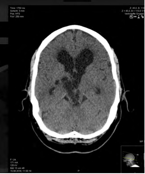 Figure 1: NECT showing cystic mass in the mesencephalon extending on the right sided thalamus with mass effect and secondary dilatation of the third and lateral ventricle.