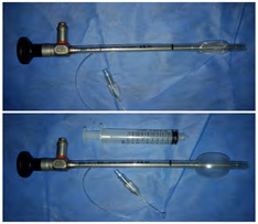 Figure 3: A 5mm, 0-degree endoscope was inserted into the tube.