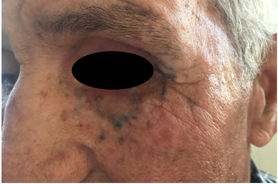 Figure 1: Multiple greyish-blue pigmented papules on suborbital area.