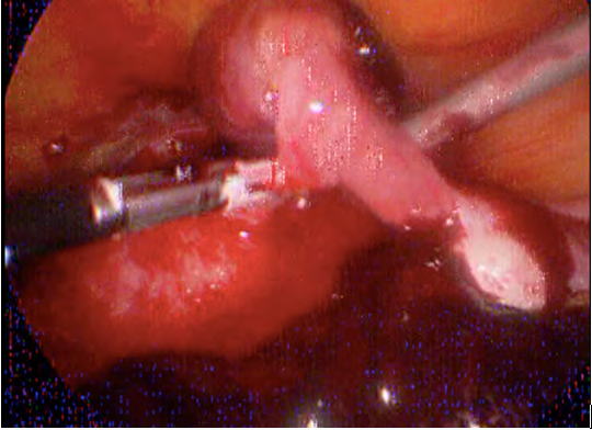 Figure 1: RT intact Ectopic pregnancy.
