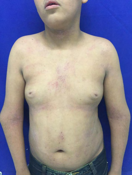 Figure 2: Hypochromic lesions in the patient, with islets of pigmentation and malformation in the upper limbs.