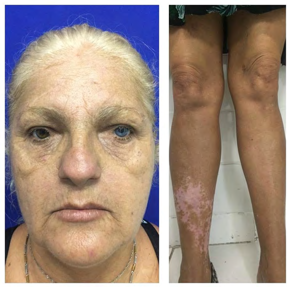Figure 3: Patient’s mother, with clinical characteristics suggestive of the condition.