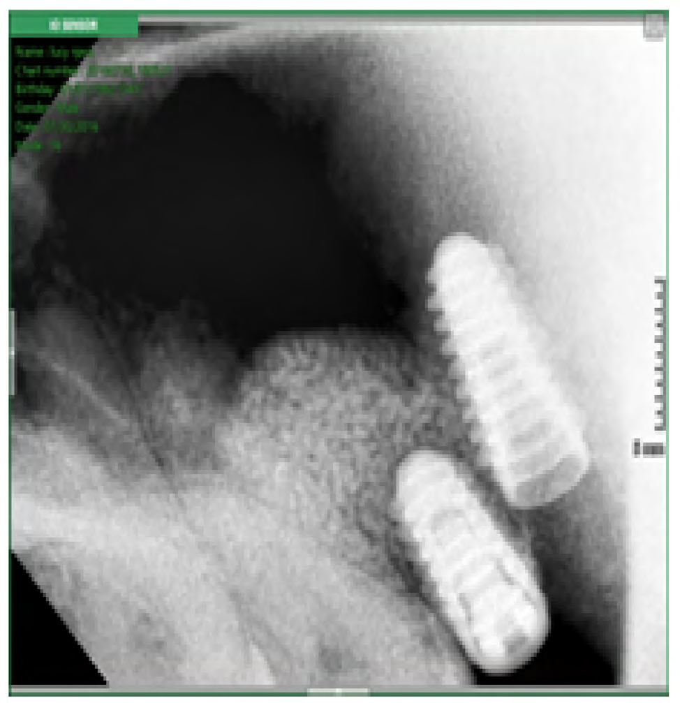 Figure 1: Patient 1 pre-op available bone height.