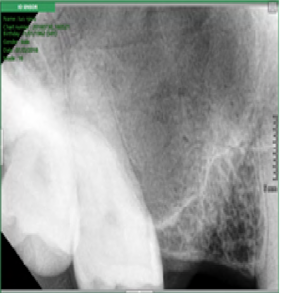 Figure 2: Patient 1 immediate post op x-ray.