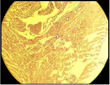 Figure 2: Fibro fatty replacement of the right ventricle myocardium at 4x magnification with Masson’s trichrome stain. The single-headed arrow points toward fibro fatty replacement. Asterisk marks the myocardium.