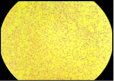 Figure 4: Histological finding of the liver demonstrates hepatic macro vesicular steatosis.