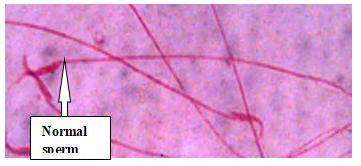 Figure 3: Plate I: Semen smears from Group 2 (Administered100mg/kg bwt of Ketoconazole Tablet), Different forms of sperm cells (Eousin Negrosine ×400). Dead and live sperms as evidenced by Richard S [3].