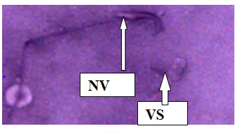 Figure 6: Plate IV: Semen smears from group 2 (100mg/ Kg bwt of Ketoconazole Tablet for five days) viable (VS) and non-viable (NV) sperm cells (Eousin- Negrosin ×400).