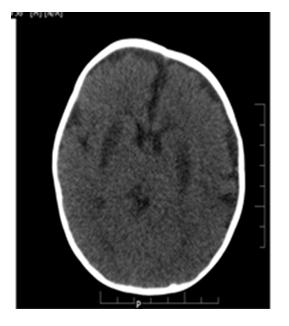Figure 2: CT Brain (Plain) at the level of basal ganglia showed bilateral symmetrical hypodensities noted in the putamen.