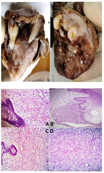Figure 1: Showing an irregular greyish white solid mass from right maxilla.
