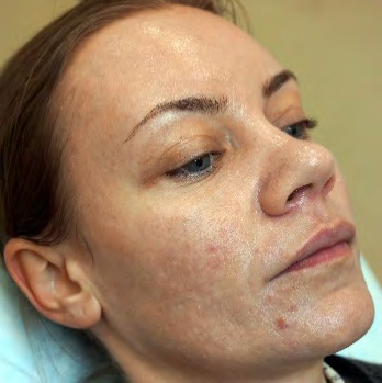 Figure 2: Patient T., female, 35 y.o.: atrophy lesion before treatment.