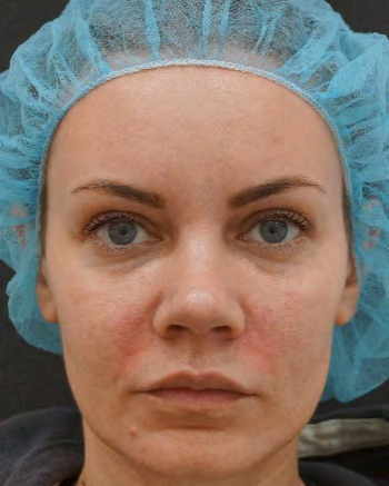 Figure 3: Patient T., female, 35 y.o.: atrophy lesion after PRP-infiltration stage.