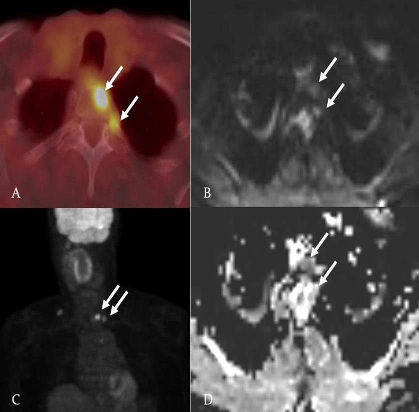 Figure 2: Fused T1-weighted TSE and PET image (A); Diffusion-weighted image (B); 3D cine PET source image (C); apparent coefficient map (D). New T2 vertebral body lesion that demonstrates abnormal metabolic activity, with an ADC mean value <1.2 × 10−3 mm2/s (1.042 <1.2 × 10−3 mm2/s), identified by white arrows.
