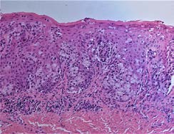 Figure 1: Hematoxylin & Eosin, magnification 200x-EMPD. Paget cells in epidermis. (a photomicrograph taken from our cases).