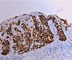 Figure 2: CK7 (cytokeratin 7), magnification 200x-Paget cells showed positivity for CK7 (also called as keratin 7, CK7, KRT 7, K7) (a photomicrograph taken from our cases).