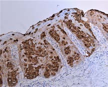 Figure 3: EMA (Epithelial membrane antigen), magnification 200x –Paget cells showed positivity for EMA (also known CD227, MUC1 or episialin) (a photomicrograph taken from our cases).