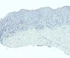 Figure 6: HMB45 (Human Melanoma Black), magnification 100x-Paget cells showed negativity for HMB45 (a photomicrograph taken from our cases).