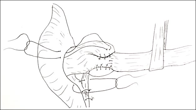 Figure 2: Partial fundoplication (for aperistaltic esophagus).