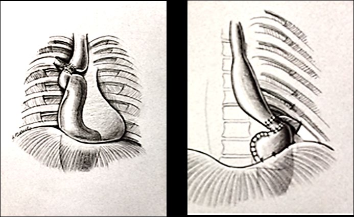 Figure 8: Right 4th intercostal pedicle; Left 8th intercostal pedicle to stem gastroesophageal reflux subsequent to esophagogastrectomy.