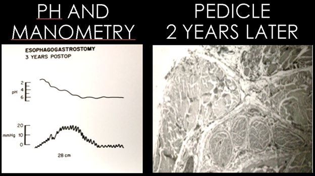 Figure 9: Left-PH and manometric studies of 3 year old pedicle patient. Right – Histology of 2 year old pedicle patient.