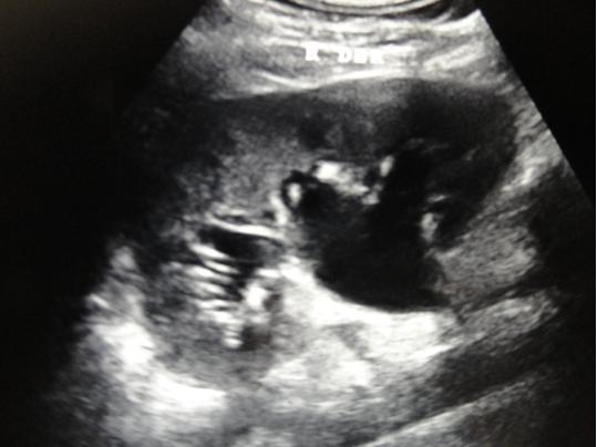 Figure 1: US Right renal with grade III hydronephrosis.