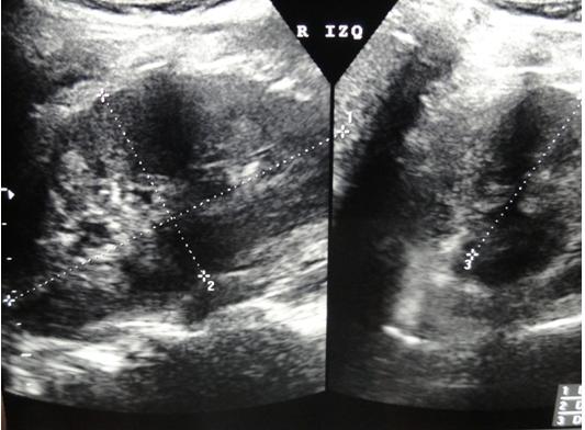 Figure 2: Left renal ultrasound where mild ectasia is seen.