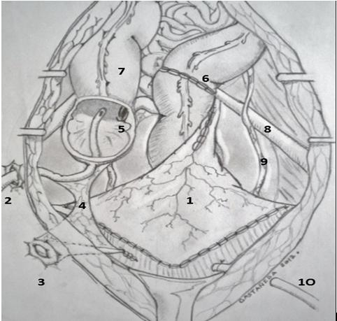 Figure 5: Illustration of colono-colonic anastomosis and appendectomy performed.