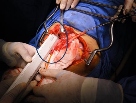 Figure 6: Photo showing the appendicular size to be used for the catheterized ducts 15 cm.