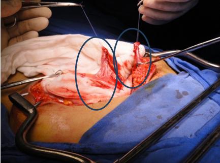 Figure 7: Photo showing the separate appendix, one part was used for the Mitrofanoff and the other segment for the Malone.