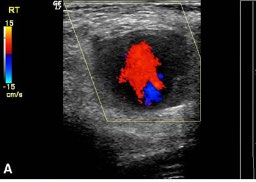 Figure 1: Duplex Scan of pseudoaneurysm showing the flow within.