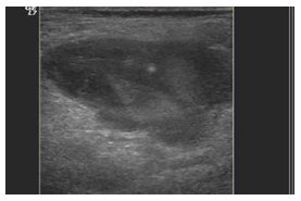 Figure 3: Thrombosis of the aneurysm after thrombin injection All patients had out-patient clinic follow-up at four weeks. The imaging findings and patient medical records were reviewed. The pseudo aneurysm size, site, thrombin dose injected, success and complication rates were obtained.
