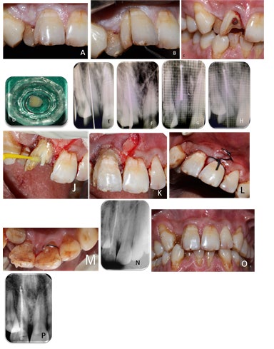 Figure 1: A) Pre-operative clinical picture, B) Separation of fracture fragment with straight probe, C) After removal of fracture fragment, D) Fragment stored in saline, E) Radiographic confirmation of working length, F) Master cone verified on radiograph, G) Obturation, H) Post space preparation and selection of fibre post evaluated on radiograph, I) Full thickness mucoperiosteal flap raised, J) Cementation of glass fibre post and application of bonding agent , K) Cementation of fragment with fibre reinforced composite, L) Single interrupted sutures placed, M) Immediate postoperative view, N) post-operative radiograph, O-P) 6 follow up.