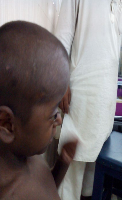 Figure 1: Short statured dysmorphic child with craniosynostosis and limb abnormalities.