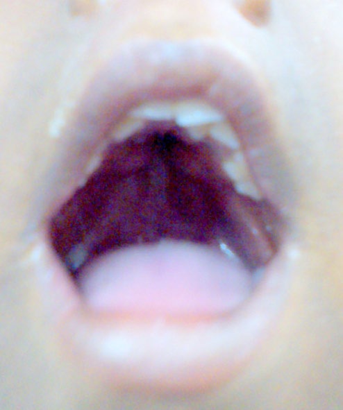Figure 2: Turri brachycephaly with proptosis and high prominent forehead.