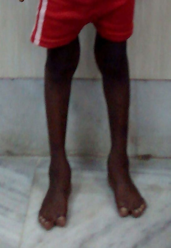 Figure 4: Mitten hands – syndactyli of 4 fingers with hitch hikers thumb (ventral view).