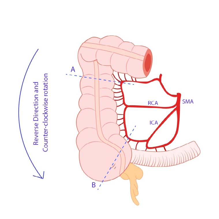 Figure 1: The cecum-ascending colon is isolated base on the right colic artery, then reverse direction and counter- clockwise rotation.