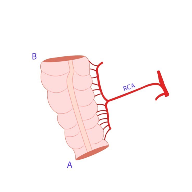 Figure 2: The isolated cecum-ascending colon segment with right colic artery pedicle.